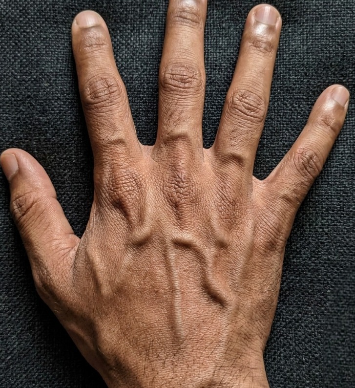 Why Prominent Hand Veins Are Often Harmless Physical Traits