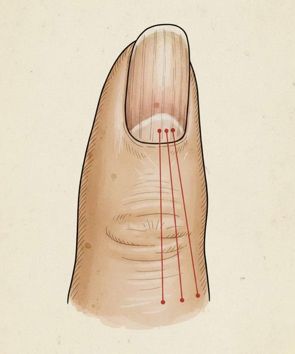Vertical Nail Ridges: Normal Changes and Nail Health